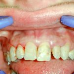 Estetická rekonštrukcia zubov fotokompozitom po ČO liečbe fixným aparátom